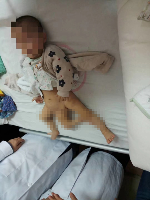 男嬰出生時有三條腿和兩個骨盆 醫生:原本是雙胞胎