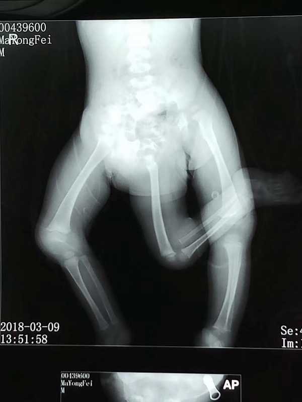 男嬰出生時有三條腿和兩個骨盆 醫生:原本是雙胞胎