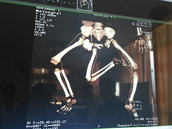 男嬰出生時有三條腿和兩個骨盆 醫生:原本是雙胞胎