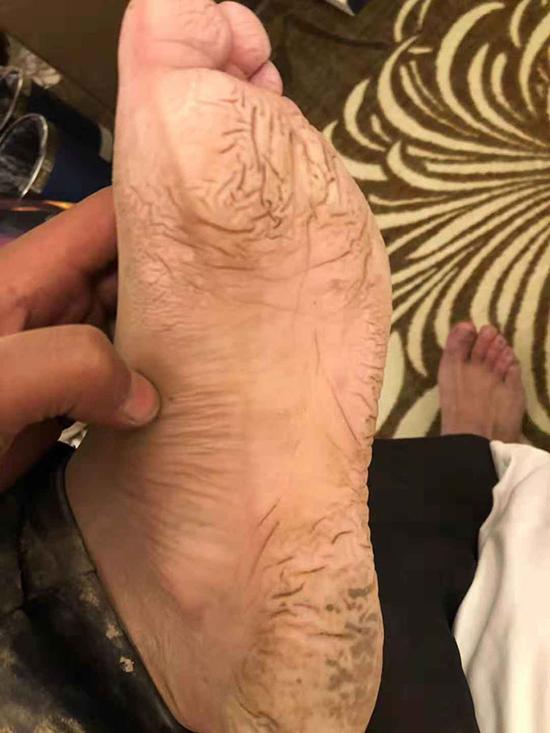 在泥濘環境中工作4天，監測員尼布的腳浮腫變形。昌都市水文局圖