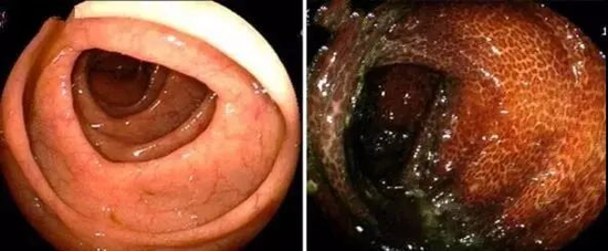 腸鏡下，正常的腸道（左）和結腸黑變病腸道對比