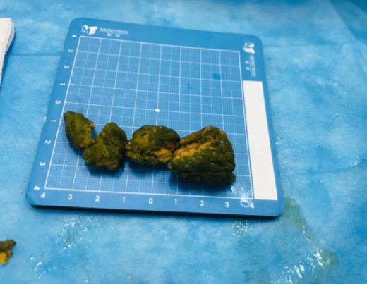 取出的胃結(jié)石