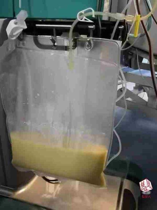 從血液中反復(fù)過濾出來的白色“脂肪液”