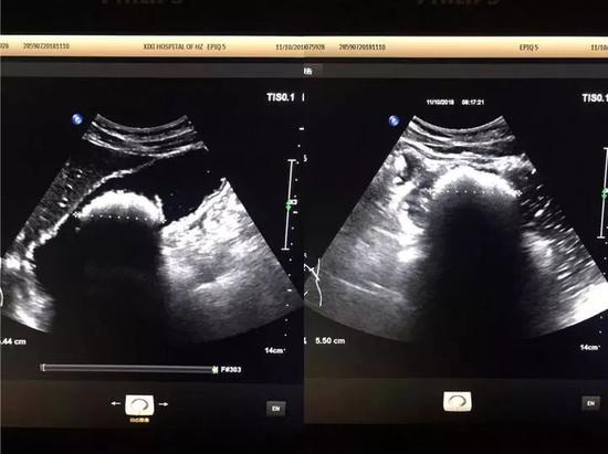 　亮亮的一團就是胃結石