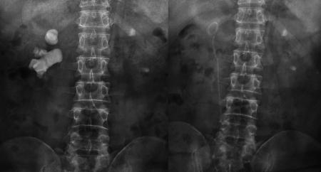 宋先生術(shù)前與第二次術(shù)后的結(jié)石對(duì)比