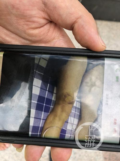 醫生安穎彥腿上的傷痕。