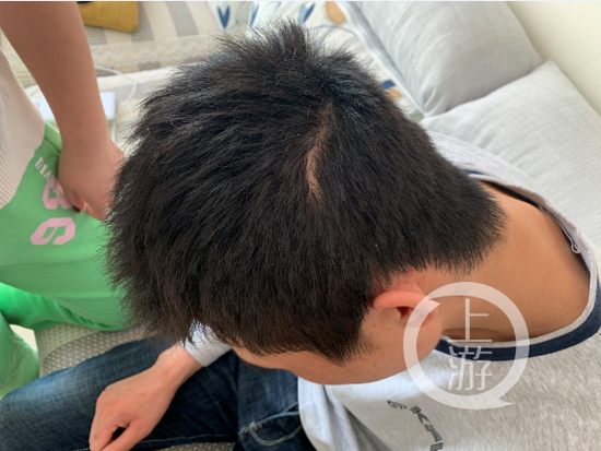 　1月22日，孫海達做勞奴時后腦被鐵皮砸中，留下明顯的凹陷。攝影/張瑩