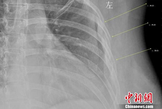 女白領(lǐng)咳斷3根肋骨不良生活習(xí)慣致骨質(zhì)疏松