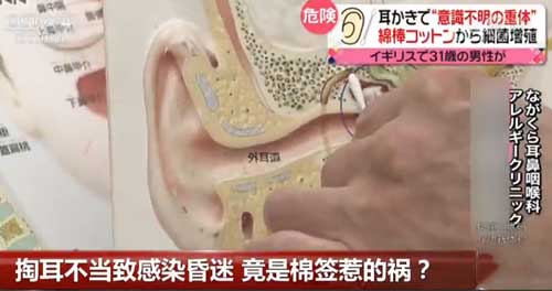 掏耳不當致感染昏迷 竟是棉簽惹的禍？