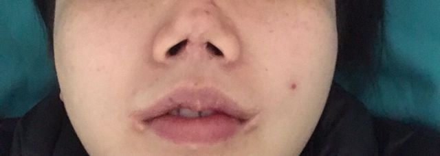 花十幾萬買來“整容噩夢”：鼻子穿孔、嘴角感染、顴骨高低不一